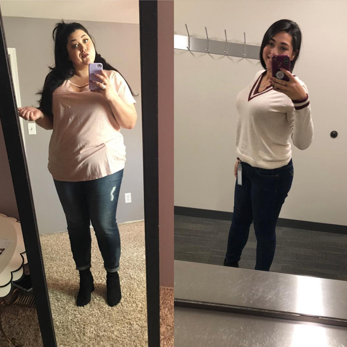 Gastric Bypass Before And After Pictures