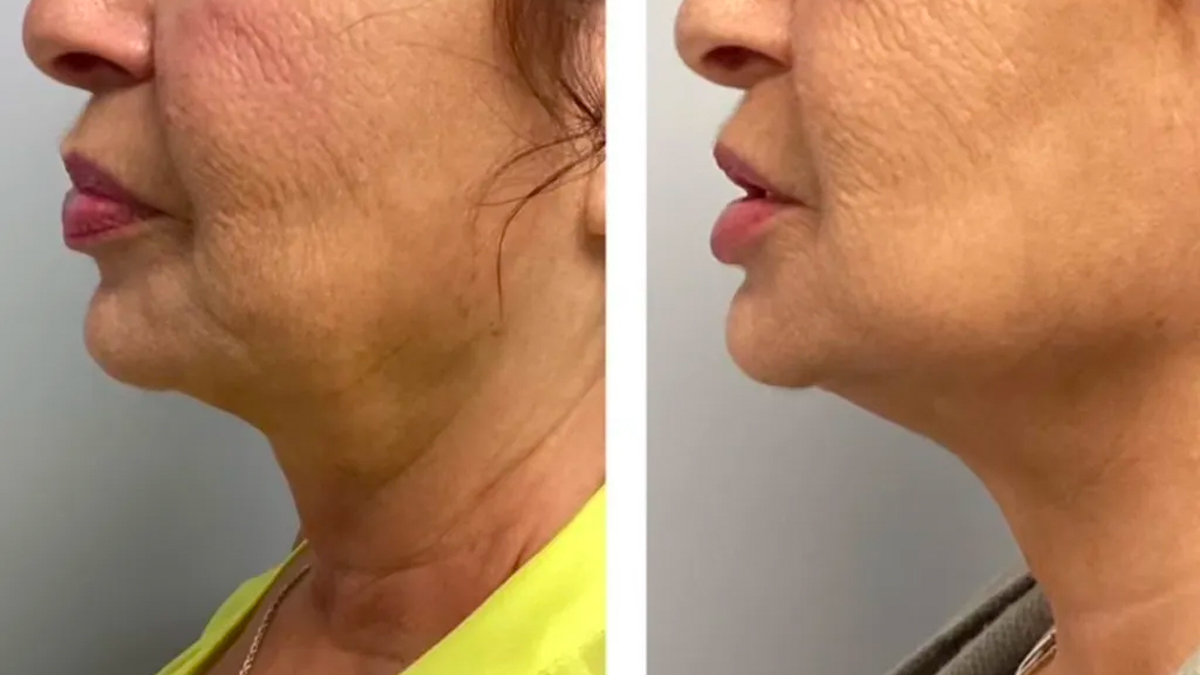 Microneedling Before and After: Photos That Show Results